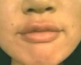 Feel Beautiful - Fuller Lips by Juvederm Ultra Plus - After Photo